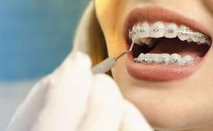 آیا ارتودنسی فقط جنبه زیبایی داد؟