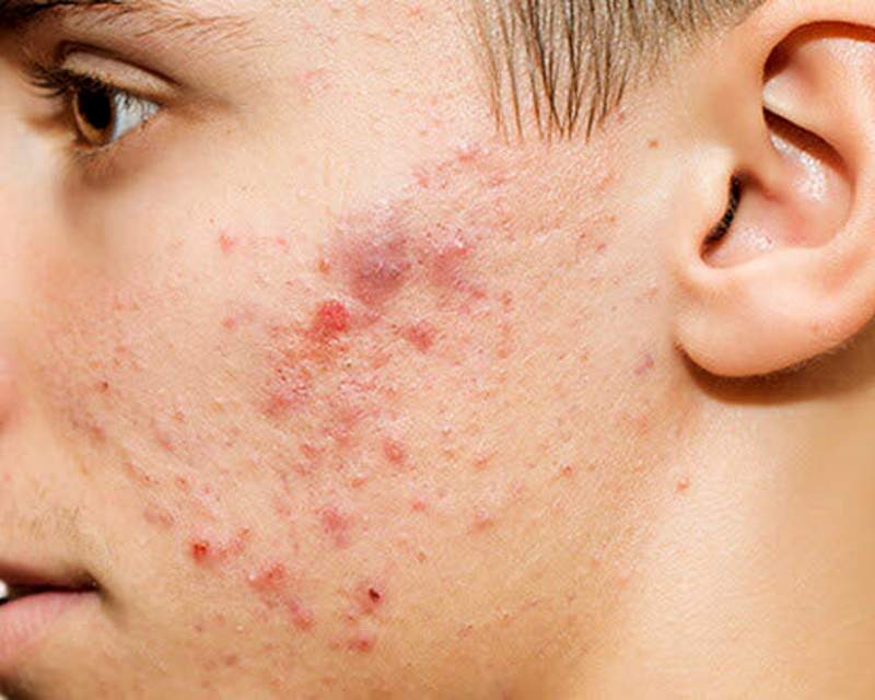 آیا لیزر جای جوش بهترین روش برای درمان این عارضه است؟