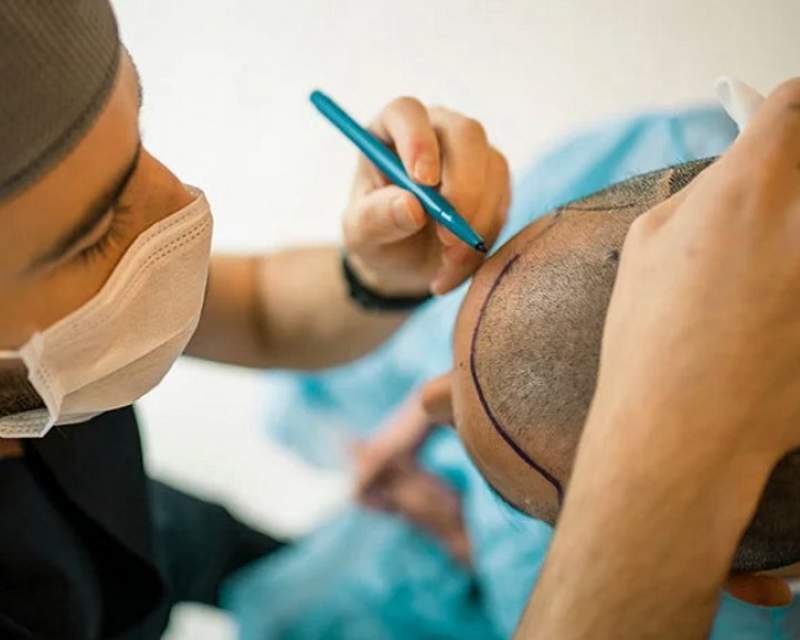 بهای ده‌ها میلیونی برای مو داشتن!